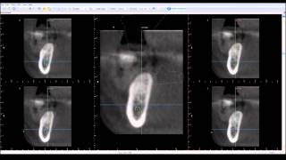 GSS Webinar - Case DF #29,30 - Articulated Model