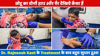 छोटू का दोनों हाथ और पैर देखिये कैसा है , और Dr. Rajneesh Kant के Treatment के बाद बहुत सुधार हुआ ||