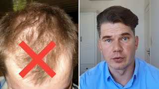No Transplant, Just Rogaine – Here’s How I Got Real Regrowth
