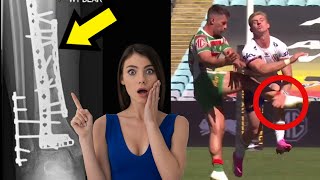 Lachlan Ilias Tibial Injury Explained!