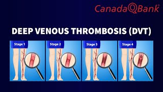 Deep Venous Thrombosis (DVT) Explained | Risk Factors, Diagnosis & Treatment | CanadaQBank