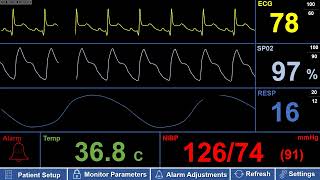 Simulated Adult Patient Monitor with ST Elevation