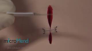 microMend - Baindaids That Work Like Stitches