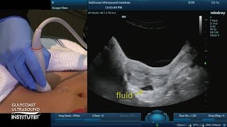 Hot Tip - Fluid in the Pouch of Douglas