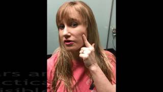 Elan Med Spa: Bellafill Testimonial