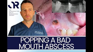 POPPING a BAD MOUTH ABSCESS
