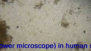 Larva of stongyloides stercoralis(SS- video: low power microscope)-from human stool