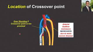 Deep Venous Arterialization: The Basics with Treatment Examples