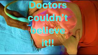 The Best ECV for breech ever. Mum's hands turn Breech.#breechbaby #baby #pregnancy #ecv #breech