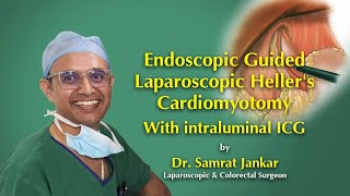 Endoscopic-Guided Laparoscopic Heller’s Myotomy with ICG | Achalasia Cardia Surgery By Dr. Samrat
