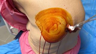 Thoracentesis of (500cc) Pleural effusion - A Patient with Liver Cancer