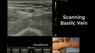 Scanning the Basilic Vein with Ultrasound