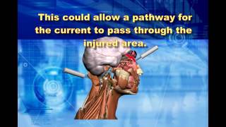 Post Concussion Therapy with Microcurrent