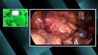 Non edited Uniportal VATS sparing lung bronchial sleeve resection for carcinoid tumor (live surgery)