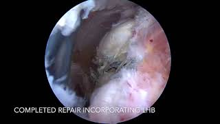 Biceps augmentation in rotator cuff repair