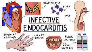 Understanding Infective Endocarditis
