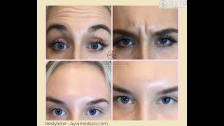 Ayla Medspa - Restylane