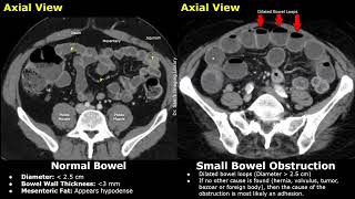 CT Abdomen Normal Bowel Vs Small Bowel Obstruction | Adhesions, Volvulus, Hernia & Other Causes