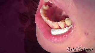 Composite dental filling !!!