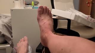 4 weeks post achilles tendon repair