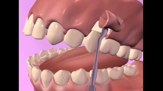 Extraction avec comblement alvéolaire et membrane
