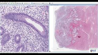 Uterus: Endometrial carcinoma Microscopy - Talking Slide