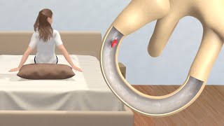 Epley Maneuver to Treat BPPV Dizziness Animation