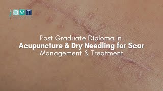 Post Graduate Diploma in Acupuncture & Dry Needling for Scar Management & Treatment