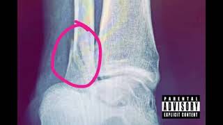 Worldwide Gary “Ankle Tape Speech” (Ankle Tape)