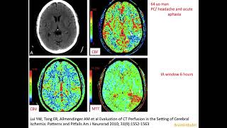73. Ischemic stroke, brain infarct; core, penumbra, thrombolysis, CT perfusion, CBF CBV