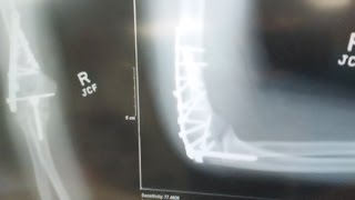 My Broken Elbow [UPDATE]