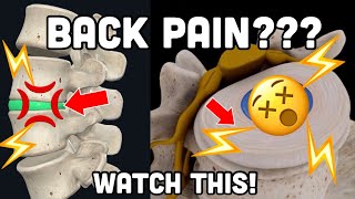 Doctor Explains: SPINE ARTHRITIS + EVERY PAINFUL Complication!