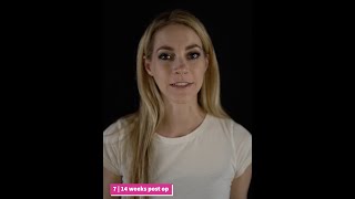 14 weeks post op | TJR + Le Fort 1 Piece + Genioplasty