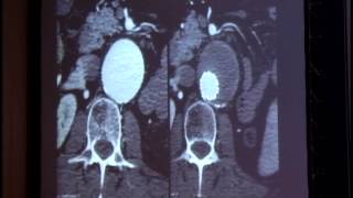 Experiência inicial nos aneurismas toracoabdominais.