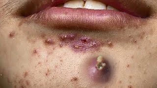 Blackhead Removal, Pimple popping, Acne Treatment
