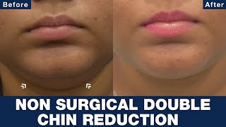 What is the most effective non-surgical method to eliminate a double chin?