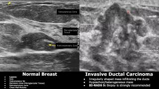 Breast Ultrasound Normal Vs Invasive Ductal Carcinoma (IDC) | BI-RADS 4/5 Masses | Breast Cancer USG