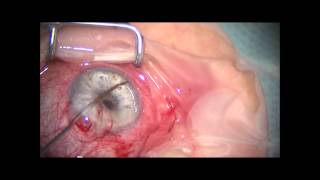Volk TVG Surgical Gonio Lens