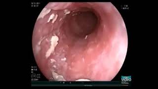 Esophageal candidiasis vagina