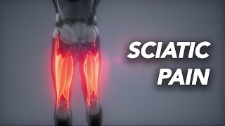 What causes SCIATIC PAIN?