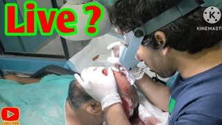 Live Sapphire Blade Procedure || Hair Transplant Procedure || Hair Transplant Method ||