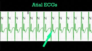Atrial ECGs