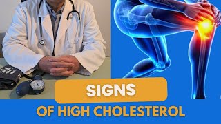 7 dangerous signs that reveal high cholesterol, and the strongest natural solution