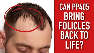 Is PP405 a miracle cure for baldness?