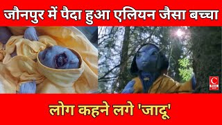 जौनपुर में जन्मा दुर्लभ साइक्लोपिया सिंड्रोम से ग्रसित शिशु, चिकित्सा जगत में चर्चा का विषय