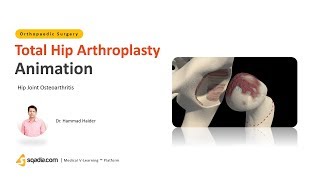 Hip Joint Osteoarthritis | Total Hip Arthroplasty | Orthopedic Surgery Lectures | V-Learning
