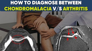 Chondromalacia vs Osteoarthritis of knee-what’s the difference? #drpankajwalecha
