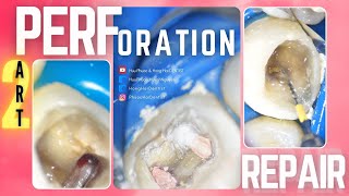 [4K] NỘI NHA LẠI VÁ THỦNG | ENDODONTIC RETREATMENT & STRIP PERFORATION REPAIR | PART 2