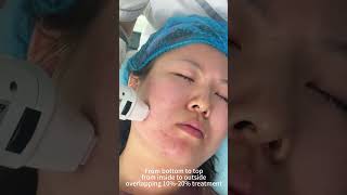 FDA 510K RF Microneedling Machine Operation Video RFMN