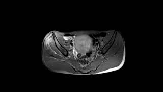Hip pain after bike crash